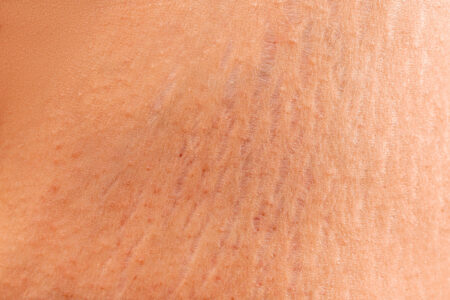 stretch marks losing weight