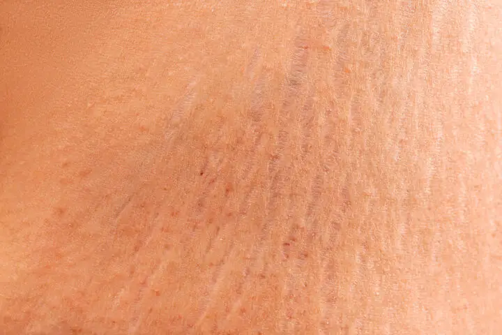 stretch marks losing weight